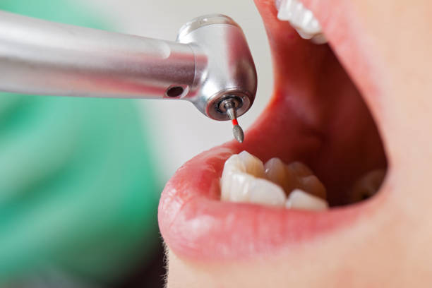 Best Emergency Tooth Extraction in Idabel, OK